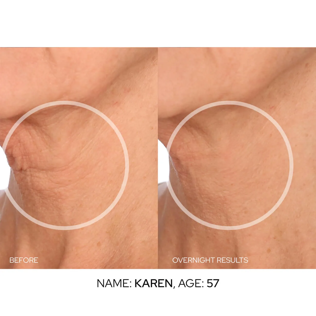 NeckLift