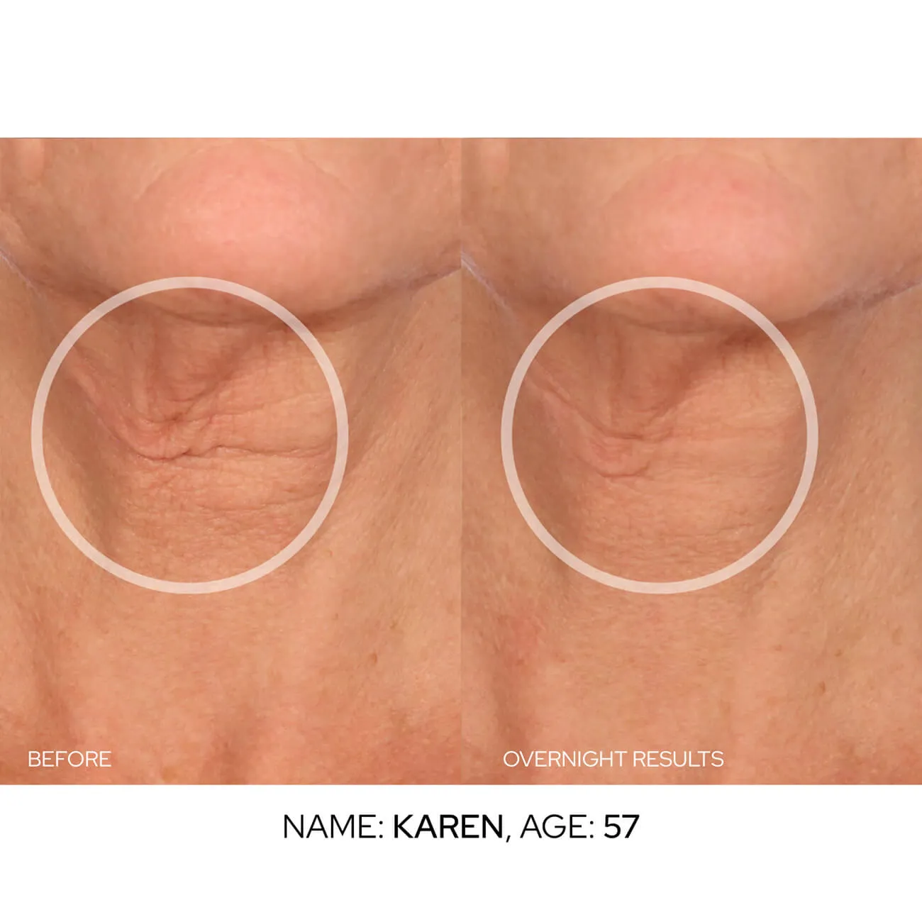 NeckLift